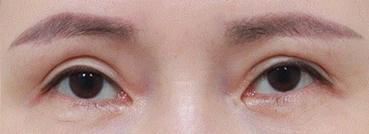 double eyelid revision surgery in korea rine plastic surgery