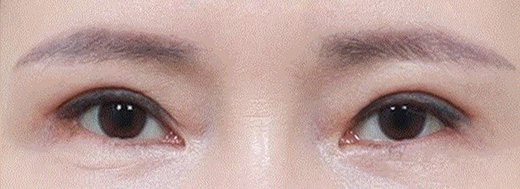 double eyelid revision surgery in korea rine plastic surgery