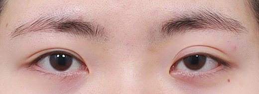 Ptosis Correction in Korea, RINE Plastic Surgery