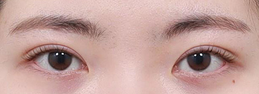 Ptosis Correction in Korea, RINE Plastic Surgery