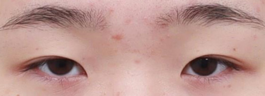 Ptosis Correction in Korea, RINE Plastic Surgery