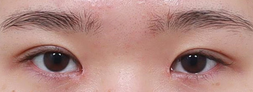 Ptosis Correction in Korea, RINE Plastic Surgery