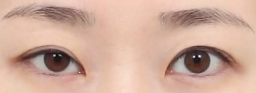 Ptosis Correction in Korea, RINE Plastic Surgery