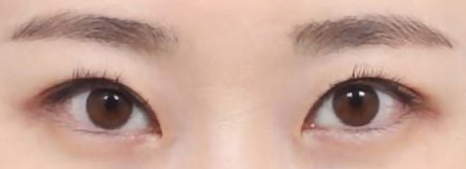 Ptosis Correction in Korea, RINE Plastic Surgery