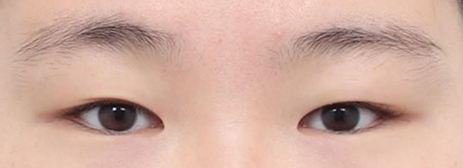 Double Eyelid Surgery in Korea, RINE Plastic Surgery
