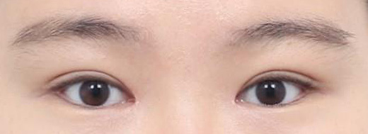 Double Eyelid Surgery in Korea, RINE Plastic Surgery