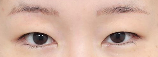 Double Eyelid Surgery in Korea, RINE Plastic Surgery