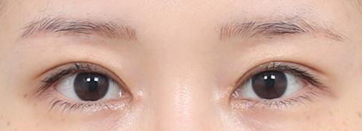 Double Eyelid Surgery in Korea, RINE Plastic Surgery