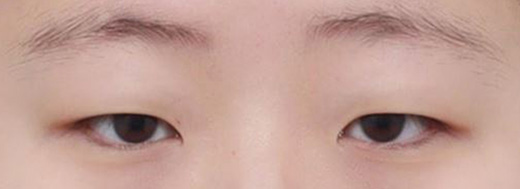 Double Eyelid Surgery in Korea, RINE Plastic Surgery