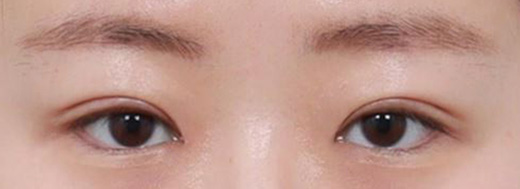 Double Eyelid Surgery in Korea, RINE Plastic Surgery